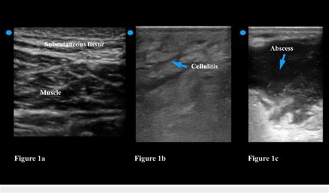 ultrasound test of soft parts|soft tissue ultrasound muscles.